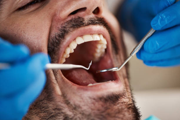 Best Emergency Root Canal Treatment in Dixon, IL